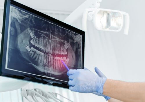 Dentist pointing at dental x-ray to show client a trouble spot.