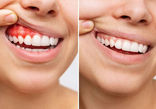 healthy human gums versus periodontal disease human gums.